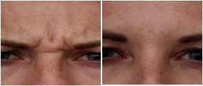 Botox Frown Lines At Lasky Aesthetics & Laser Cente, Medical Spa In Beverly Hills, California (2)