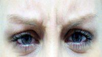 Botox Frown Lines By Dr William P. Mack, MD, PA, Tampa Oculoplastic Surgeon