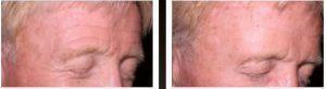 Botox Frown Lines By Dr. Henry G. Wells Jr, MD, Plastic Surgeon In Lexington, Kentucky (1)