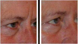 Botox Frown Lines By Dr. Henry G. Wells Jr, MD, Plastic Surgeon In Lexington, Kentucky (2)