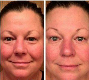 Botox Help Bags Under Eyes