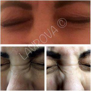 Botox In Bunny Lines Before After