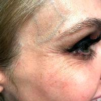 Botox In Crow's Feet Helps Under Eye Wrinkles