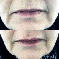 Botox In Smokers Lines Before And After (1)