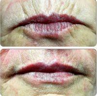 Botox In Smokers Lines Before And After (10)