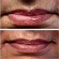 Botox In Smokers Lines Before And After (14)