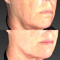 Botox In Smokers Lines Before And After (3)