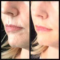 Botox In Smokers Lines Before And After (6)