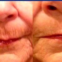 Botox In Smokers Lines Before And After (7)