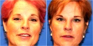 Botox In The Forehead And Crows Feet And One Syringe Of Radiesse In The Nasolabial Folds By Dr. Avron Lipschitz, MD, Palm Beach Gardens, FL Plastic Surgeon