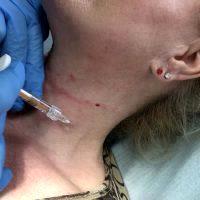 Botox In The Neck For Wrinkles Photos