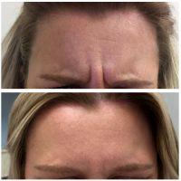 Botox Injection Is A Pretty Popular Solution For Patients