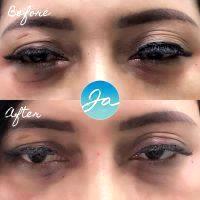 Botox Injection Lower Eyelid Before And After Photo