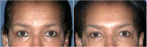 Botox Injection Wrinkles On The Forehead By Dr. David Mabrie, San Francisco