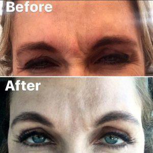 Botox Injections Between Brows And Also To Crows Feet By Dr. Scott K. Thompson,Salt Lake City