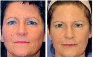 Botox Injections By Dr. S. Kent Brown, Plastic Surgeon, In Scottsdale, Arizona