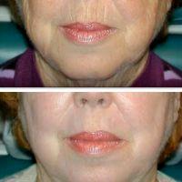 Botox Injections For Lips
