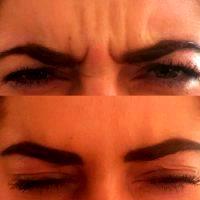 Botox Injections For The Glabella Or Nasal Region