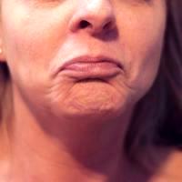 Botox Injections In The Chin Area