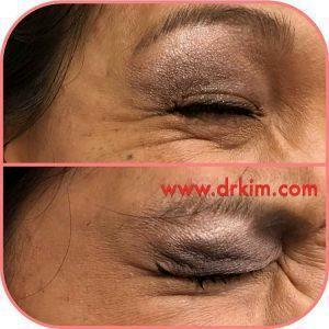 Botox Injections In The Crow's Feet By Dr.Kim,San Francisco