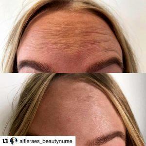 Botox Injections In The Forehead Wrinkles By Dr. Scott K. Thompson,Salt Lake City
