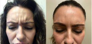 Botox Injections Of Forehead Wrinkles And Frown Lines By DR. SHAUN PARSON,Arizona
