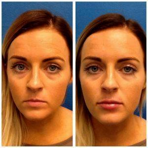 Botox Injections Of The Forehead By SHARI QUAI, APRN Medical Supervisor & Injector,Salt Lake City