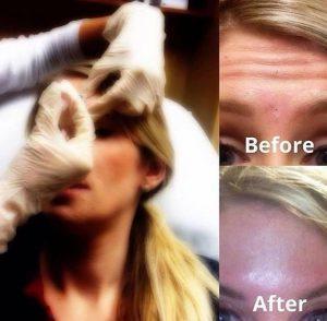 Botox Injections The Forehead At National Laser Institute Med Spa, Scottsdale, AZ