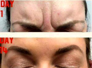 Botox Injections The Glabella, And A Little Eyebrow Lift, AtNational Laser Institute Med Spa, Scottsdale, AZ
