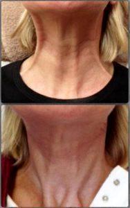 Botox Injections To Soften An Ageing Neck Before & After