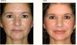 Botox Injectons To The Marionette Lines By Dr. Stanley Jacobs', San Francisco