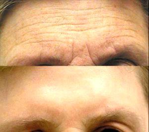 Botox Inlections At Gateway Aesthetic Institute And Laser Center,Salt Lake City