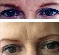 Botox Is A Fabulous Injection For Reducing Lines On The Forehead Area