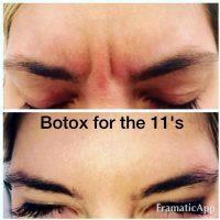 Botox Is A Toxin That Paralyzes Muscles It's Injected Into