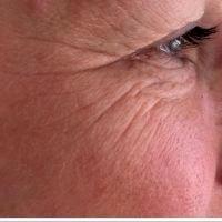 Botox Is An Ideal Option For Patients Who Want To Avoid Surgery