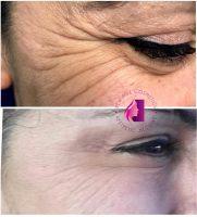Botox Is Effective In Preventing The Progression And Appearance Of Wrinkles