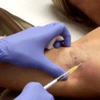 Botox Is Safe And Effective For Hyperhidrosis
