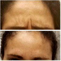 Botox Is Used To Correct Forehead Wrinkles