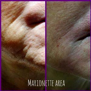 Botox Marionette Lines Before And After (1)