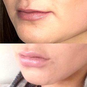 Botox Marionette Lines Before And After (10)