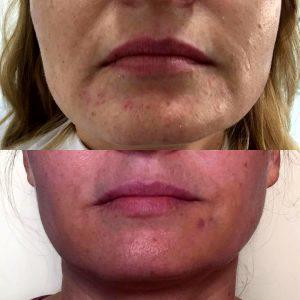 Botox Marionette Lines Before And After (11)