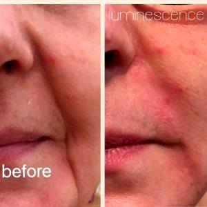 Botox Marionette Lines Before And After (12)