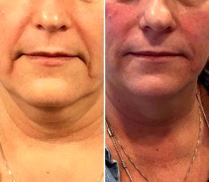 Botox Marionette Lines Before And After (13)