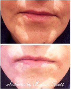 Botox Marionette Lines Before And After (15)