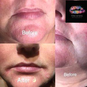Botox Marionette Lines Before And After (16)