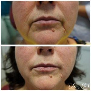 Botox Marionette Lines Before And After (17)