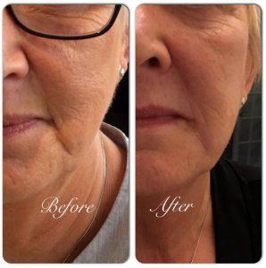 Botox Marionette Lines Before And After (5)