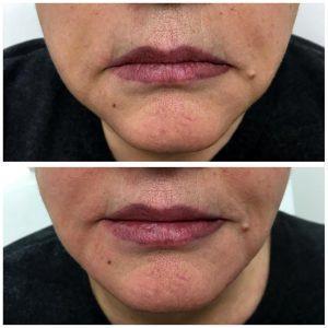 Botox Marionette Lines Before And After (6)