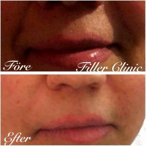 Botox Nasolabial Folds Before And After Photos (1)