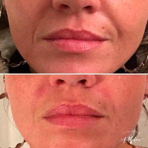 Botox Nasolabial Folds Before And After Photos (3)
